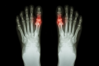 Risks and Triggers for Gout