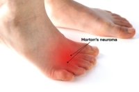 Symptoms and Treatment of Morton’s Neuroma